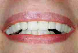 After Dental Veneers Treatment Testimonial