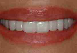 After Dental Crowns Treatment Testimonial